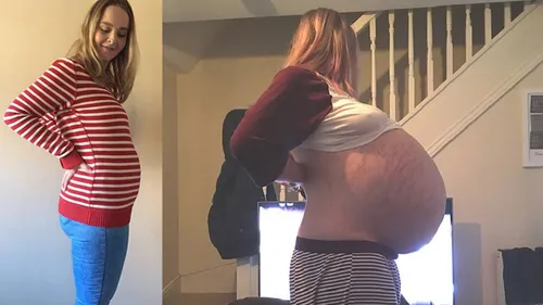 Tout le monde pensait qu'elle était enceinte mais c'était un kyste...